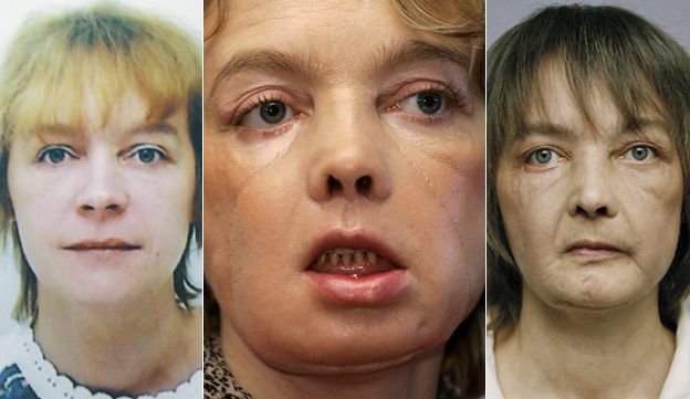 2005 World’s first successful partial face transplant