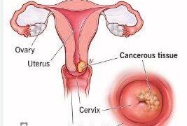 Stakeholders raise alarm over rising cases of cervical cancer