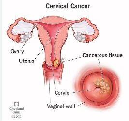 Stakeholders raise alarm over rising cases of cervical cancer